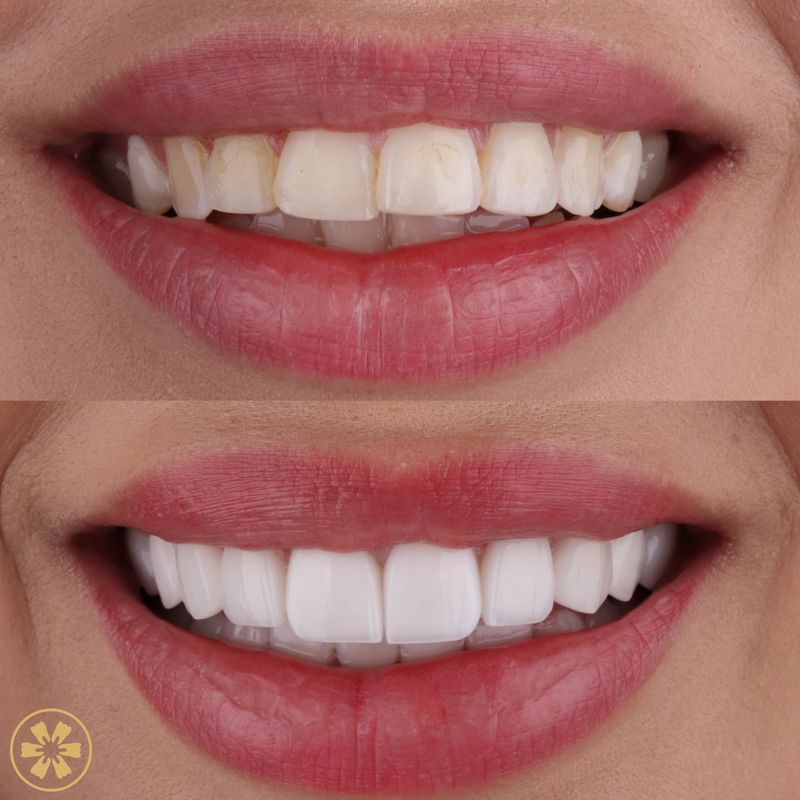 Before and after: a Hollywood Smile case at Creative Arts Dubai