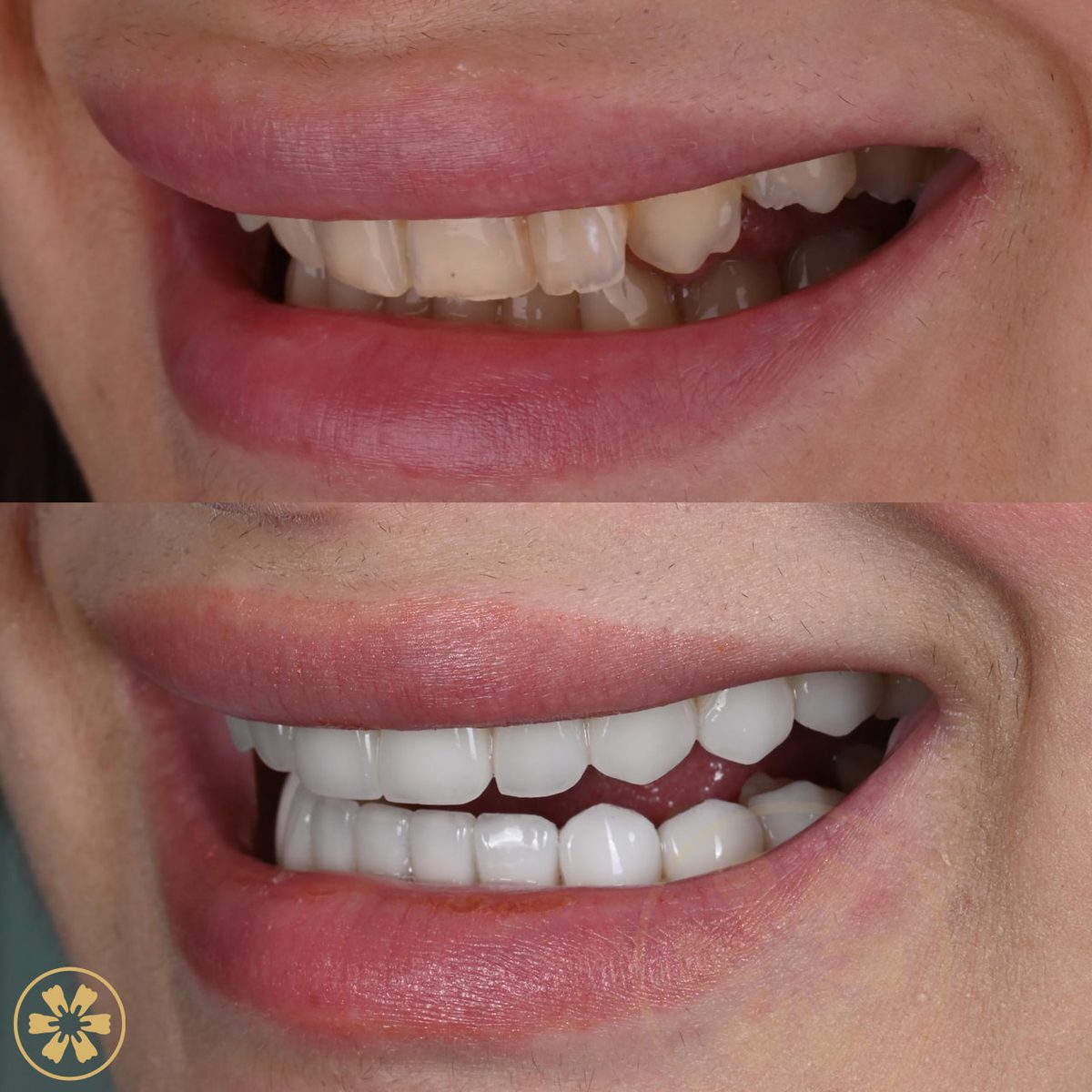 Sorriso con faccette Creative Arts, Dubai