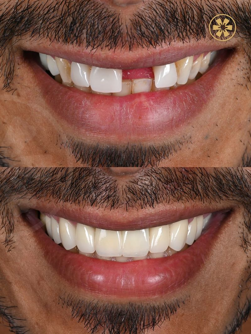 Before and after: a gap left by a missing upper tooth, restored at Creative Arts Dubai