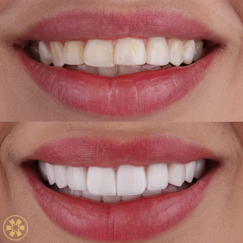 Before and after: Nataly's Hollywood smile at Creative Arts Dubai (view 1)