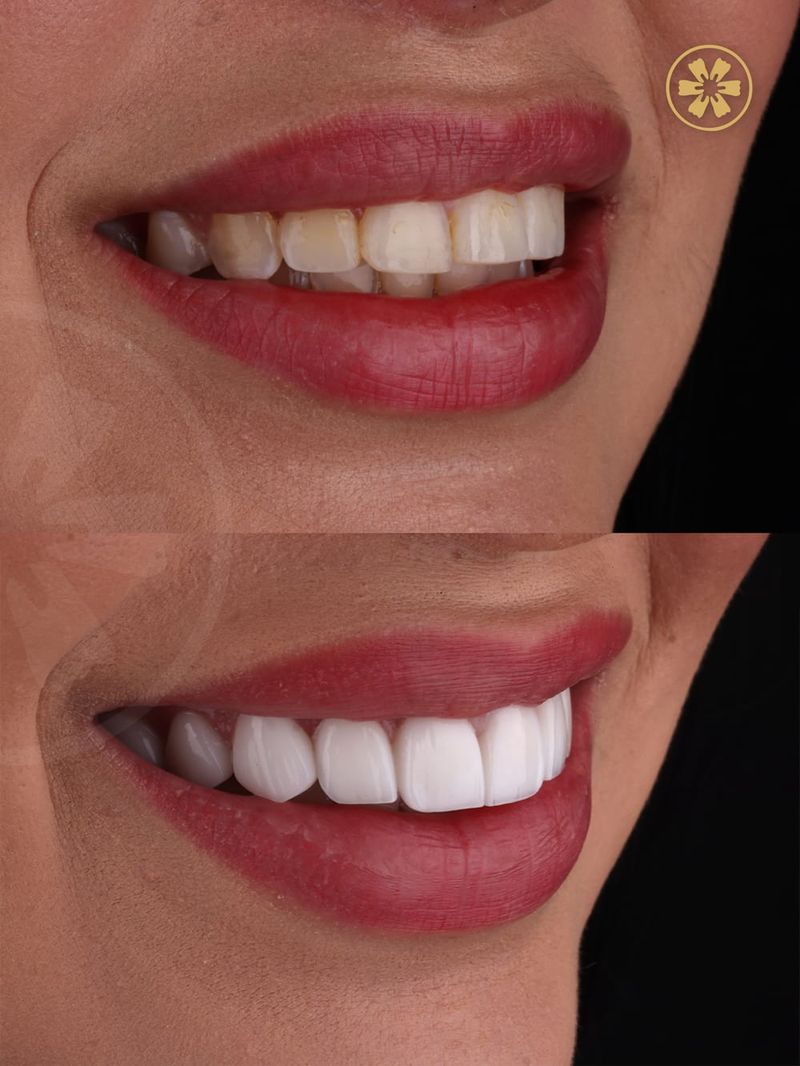 Before and after smile photo of a patient treated at Creative Arts Dubai