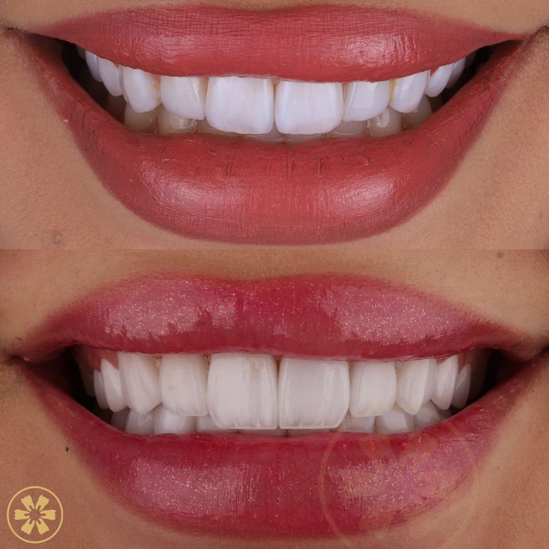 Parshang's full smile rehabilitation, before and after (view 1), with Dr. Khalid Saeed at Creative Arts Dubai