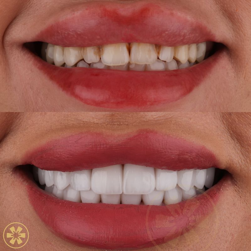 Before and after: porcelain veneers at Creative Arts Dubai