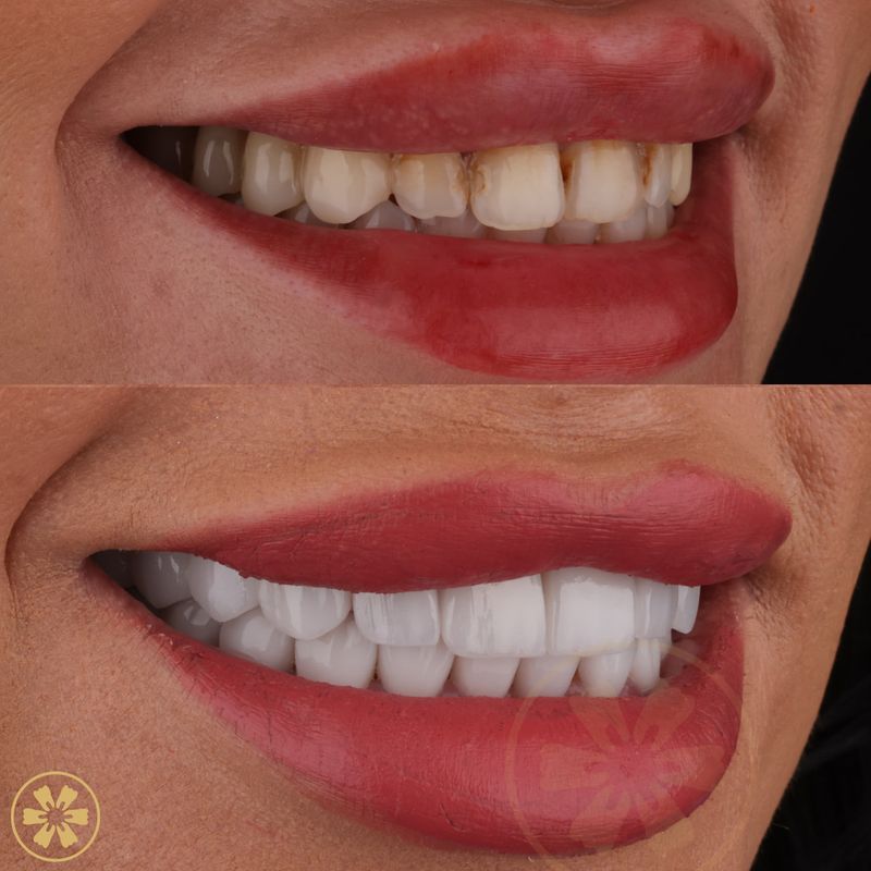 Shahed's porcelain veneers, before and after (view 3), at Creative Arts Dubai