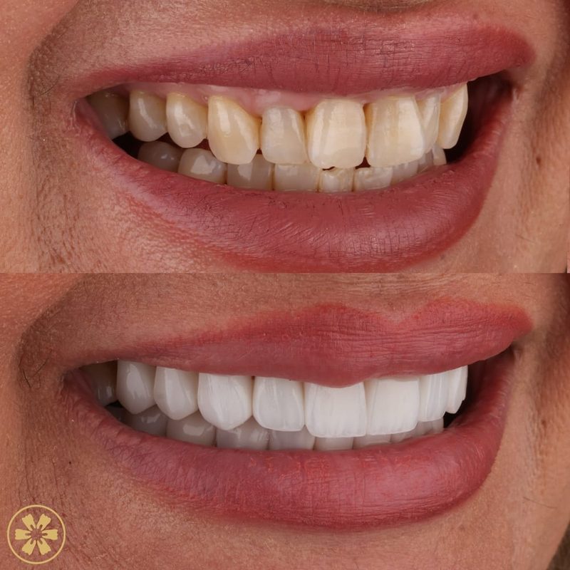 Quanto costa un sorriso Hollywood a Dubai?
