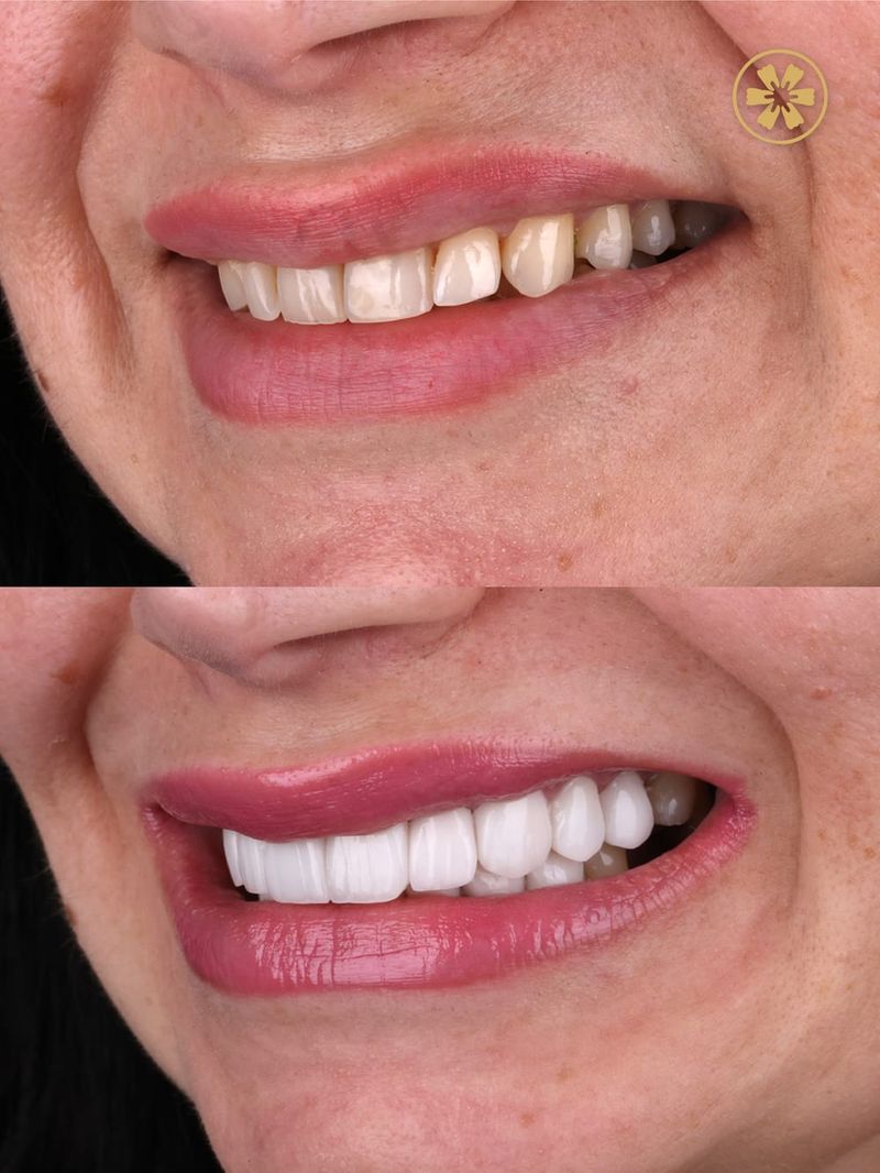 Veneers before and after, treated by Dr. Khalid Saeed at Creative Arts Dubai