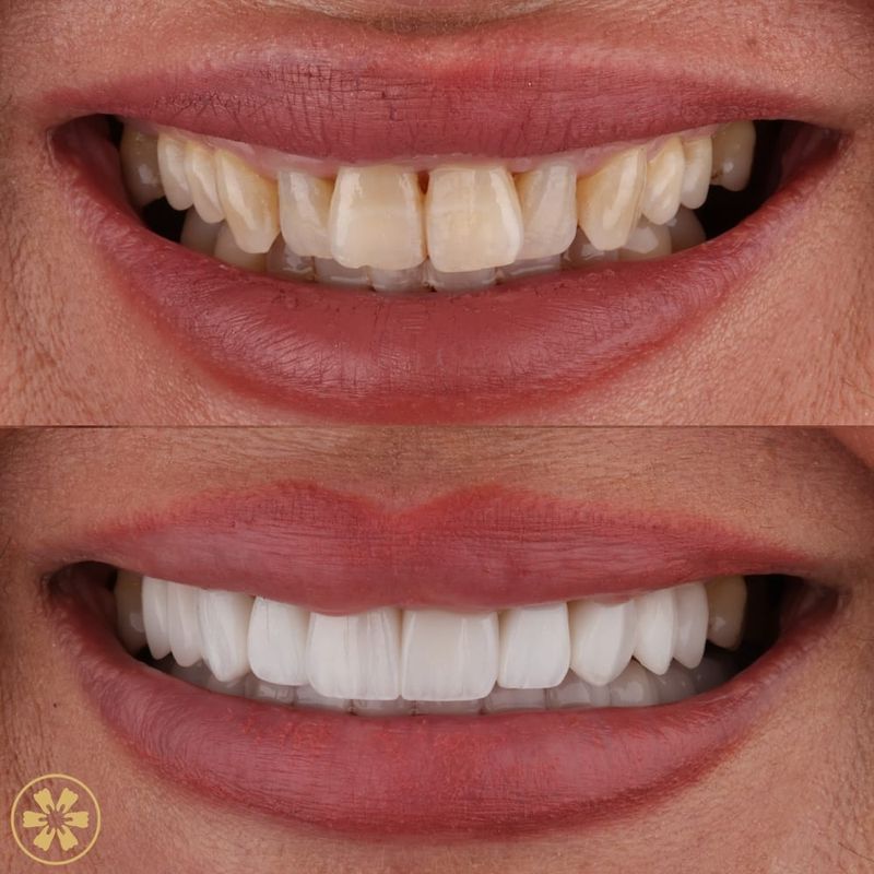 Before and after: yellowed teeth restored with ceramic at Creative Arts Dubai