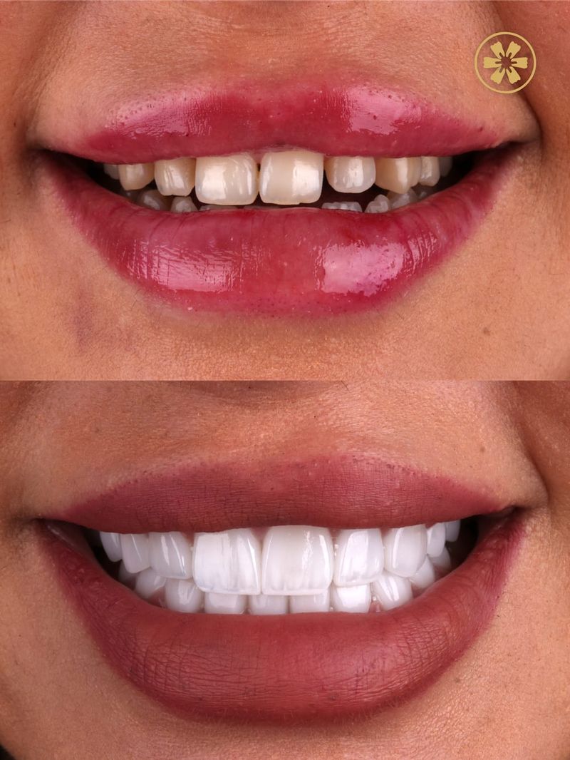 Before and after smile photo of a patient treated at Creative Arts Dubai