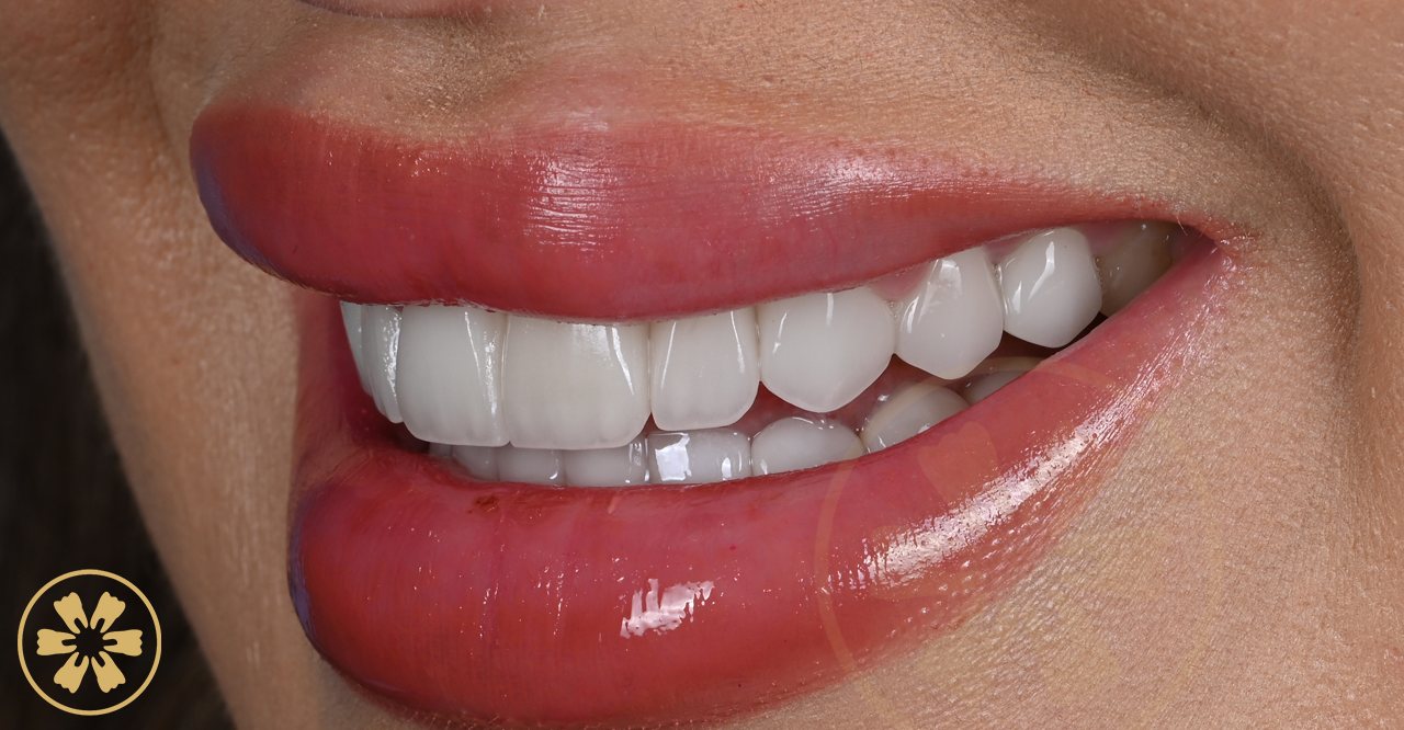 Smile with porcelain veneers — Creative Arts Dental & Aesthetics, Dubai
