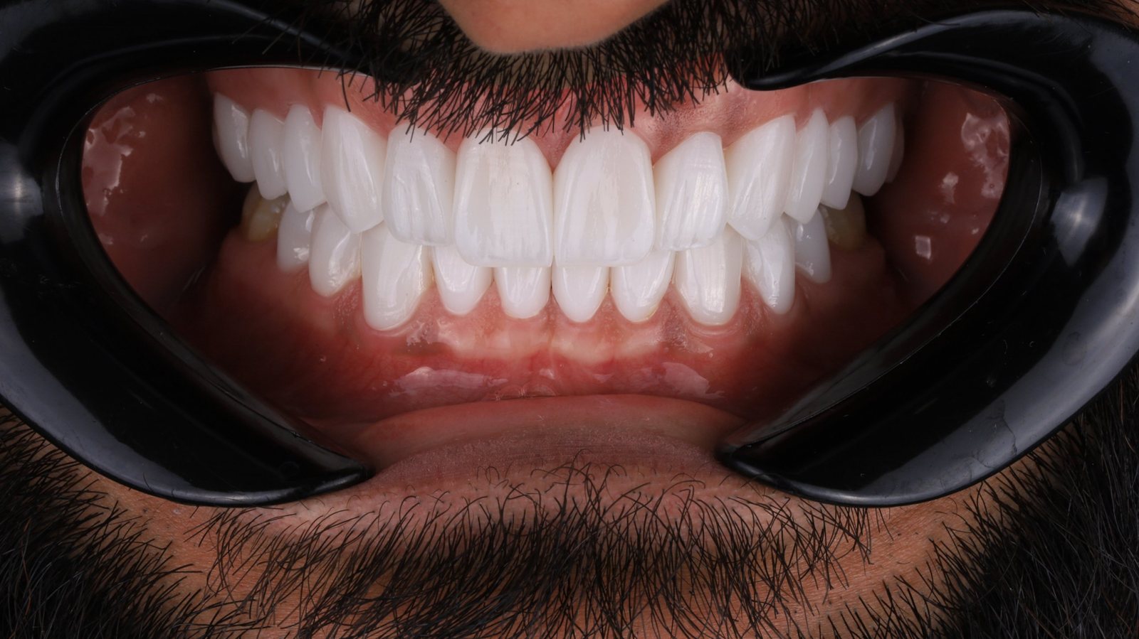 Smile with porcelain veneers — Creative Arts Dental & Aesthetics, Dubai