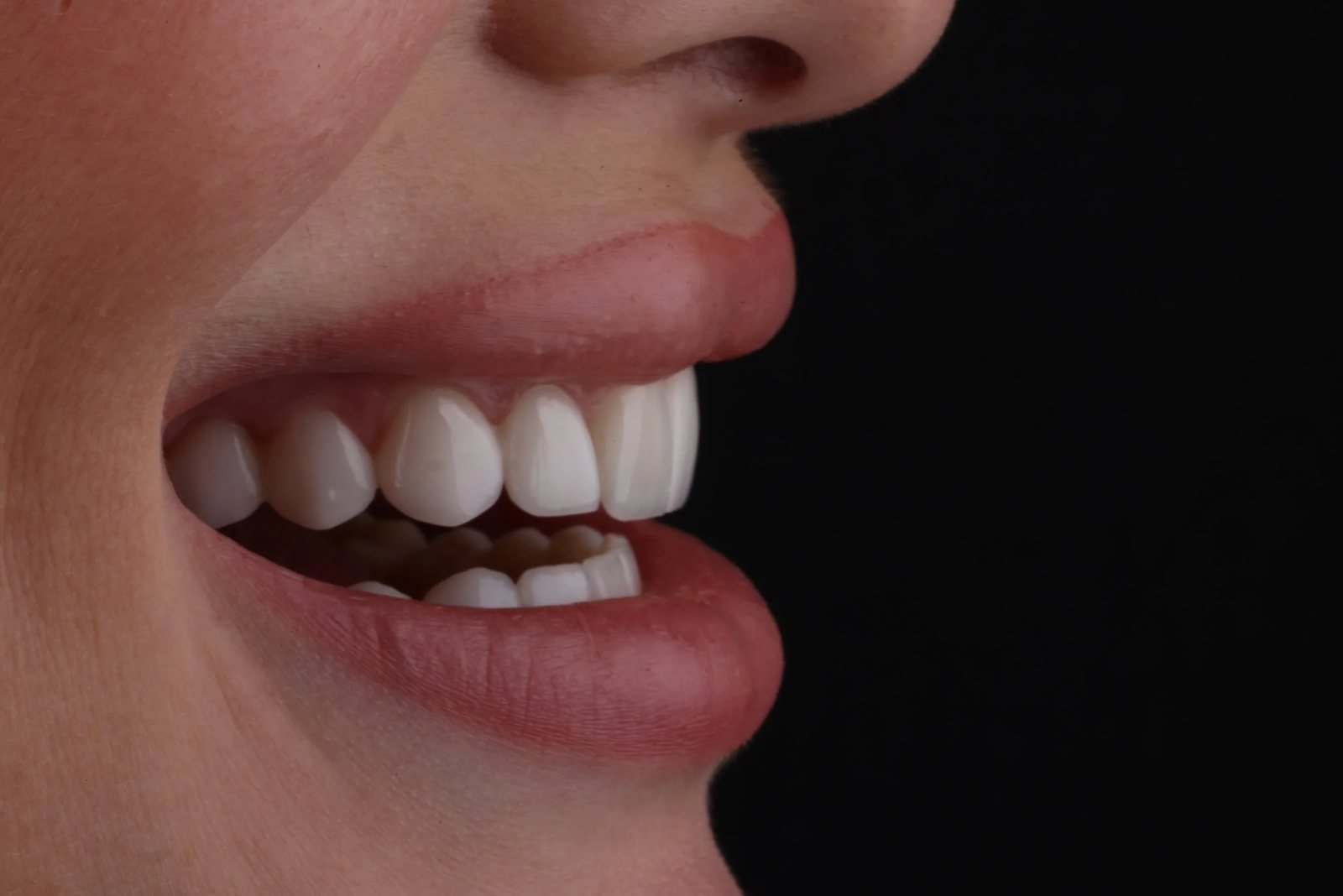 Smile with porcelain veneers — Creative Arts Dental & Aesthetics, Dubai