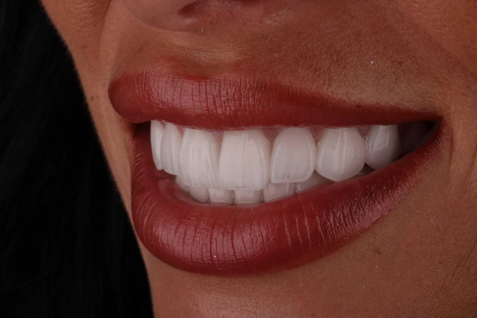 Smile with porcelain veneers — Creative Arts Dental & Aesthetics, Dubai