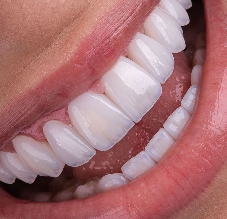 Lächeln mit Veneers — Creative Arts Dental & Aesthetics, Dubai