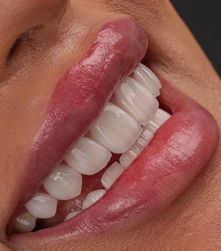 Sorriso con faccette — Creative Arts Dental & Aesthetics, Dubai