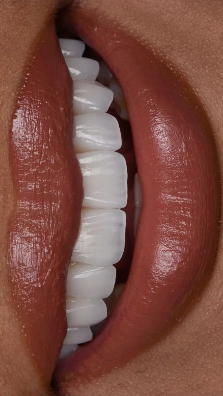 Smile with porcelain veneers — Creative Arts Dental & Aesthetics, Dubai