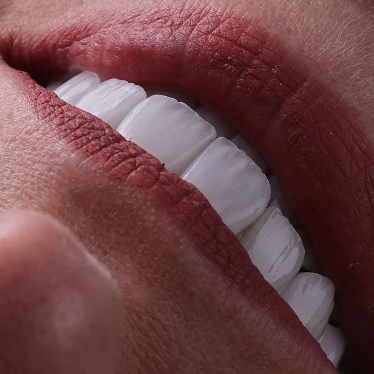 Smile with porcelain veneers — Creative Arts Dental & Aesthetics, Dubai