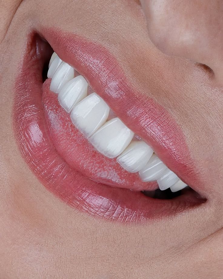 لبخند با لمینت — Creative Arts Dental & Aesthetics، دبی