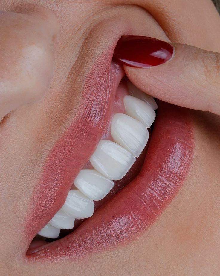 Smile with porcelain veneers — Creative Arts Dental & Aesthetics, Dubai