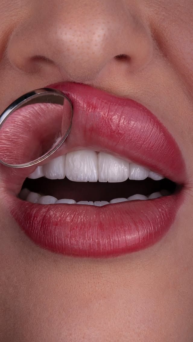 Smile with porcelain veneers — Creative Arts Dental & Aesthetics, Dubai