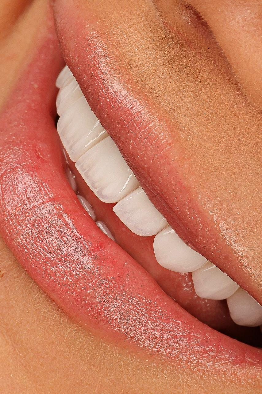 Smile with porcelain veneers — Creative Arts Dental & Aesthetics, Dubai