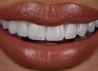 Smile with porcelain veneers — Creative Arts Dental & Aesthetics, Dubai