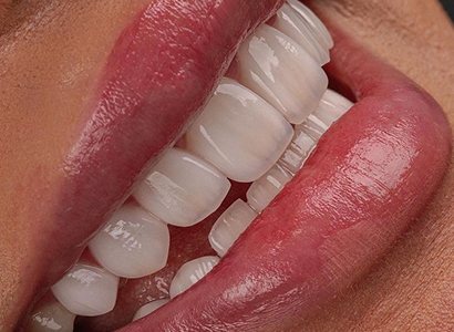 Smile with porcelain veneers — Creative Arts Dental & Aesthetics, Dubai