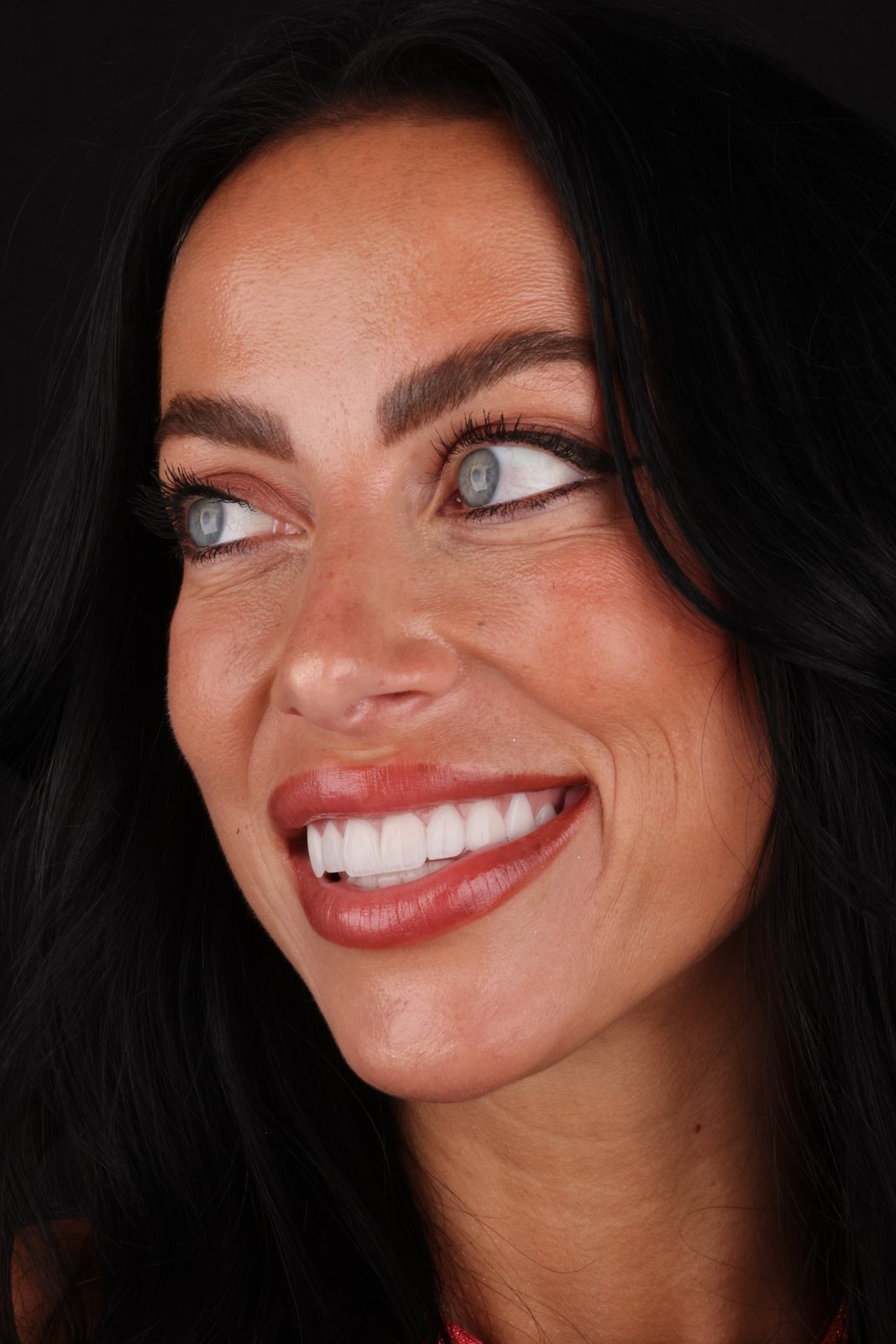 لبخند با لمینت — Creative Arts Dental & Aesthetics، دبی