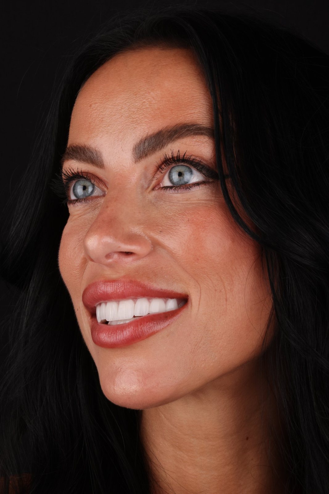 Lächeln mit Veneers — Creative Arts Dental & Aesthetics, Dubai