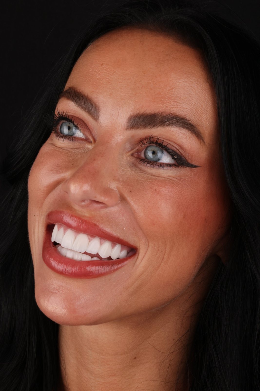 Smile with porcelain veneers — Creative Arts Dental & Aesthetics, Dubai