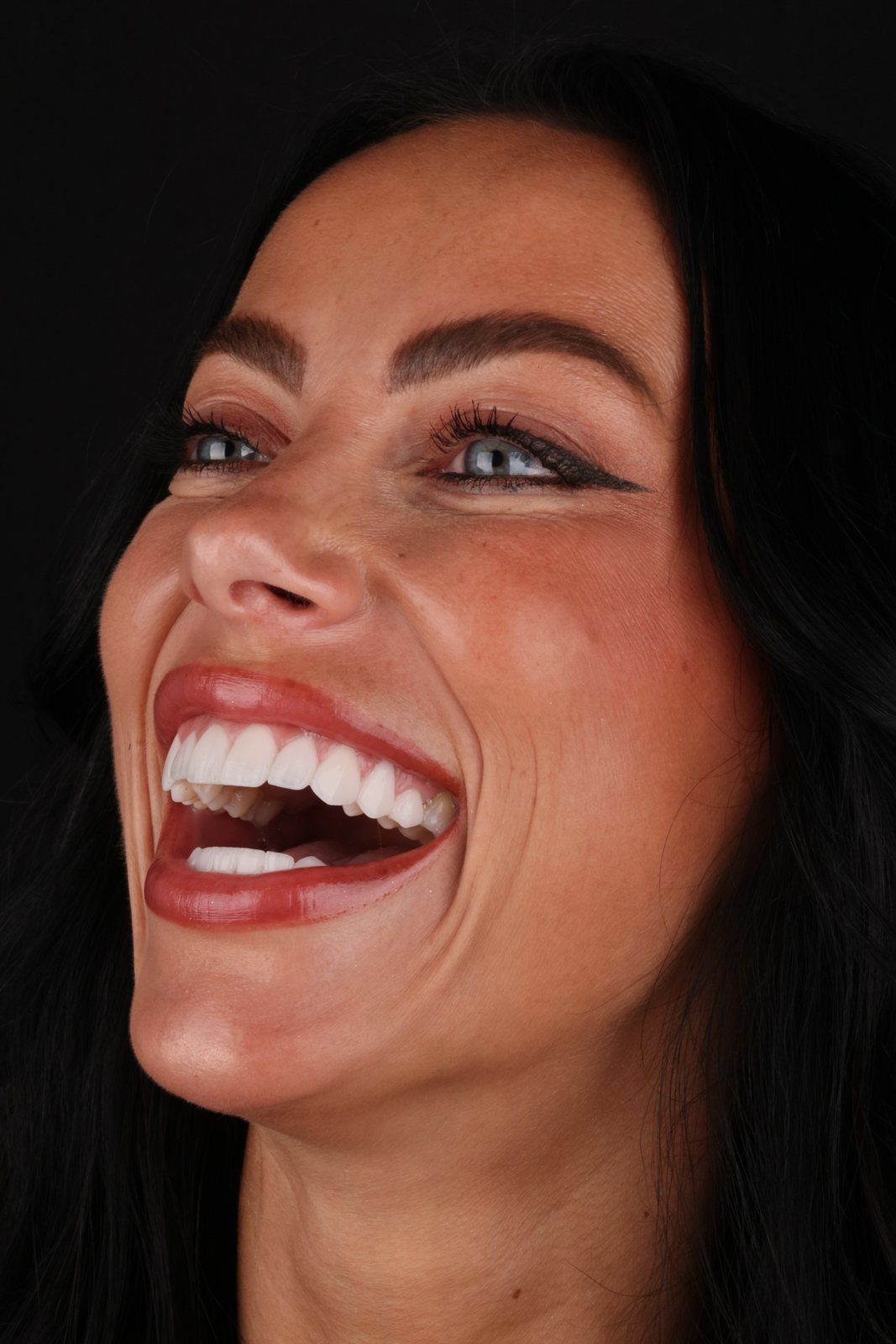 Smile with porcelain veneers — Creative Arts Dental & Aesthetics, Dubai