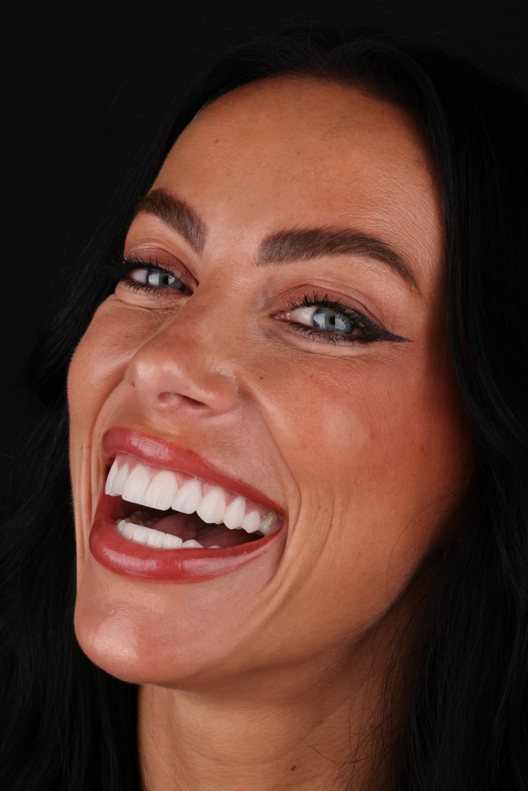 Sorriso con faccette — Creative Arts Dental & Aesthetics, Dubai