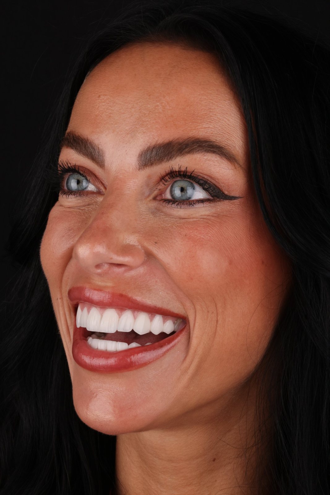 Smile with porcelain veneers — Creative Arts Dental & Aesthetics, Dubai