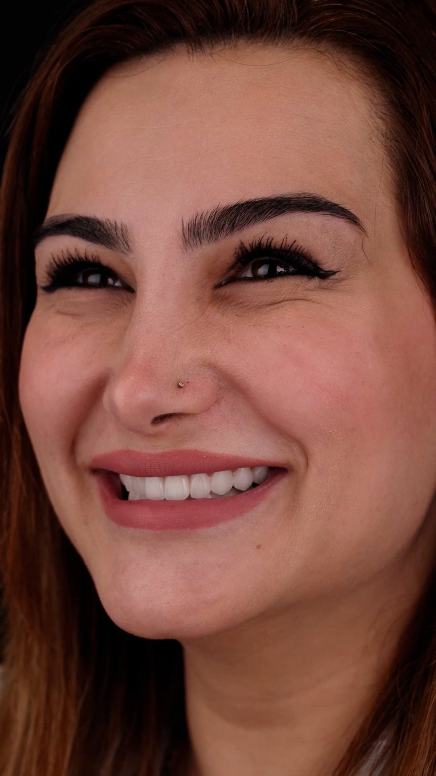 لبخند با لمینت — Creative Arts Dental & Aesthetics، دبی