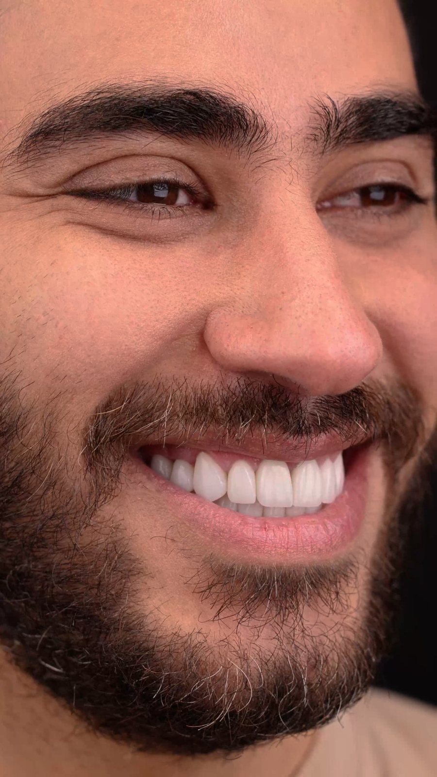 Smile with porcelain veneers — Creative Arts Dental & Aesthetics, Dubai