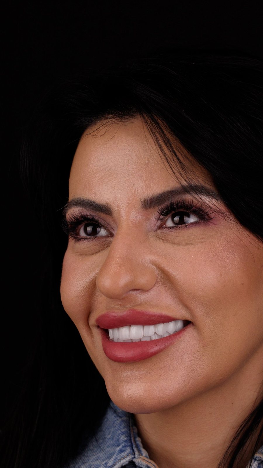 Smile with porcelain veneers — Creative Arts Dental & Aesthetics, Dubai