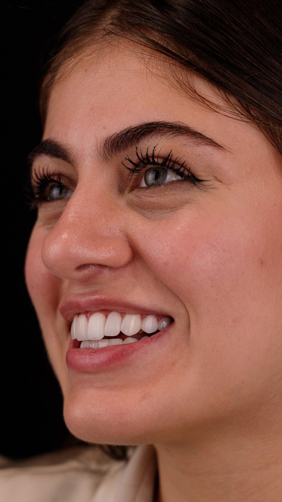 Smile with porcelain veneers — Creative Arts Dental & Aesthetics, Dubai