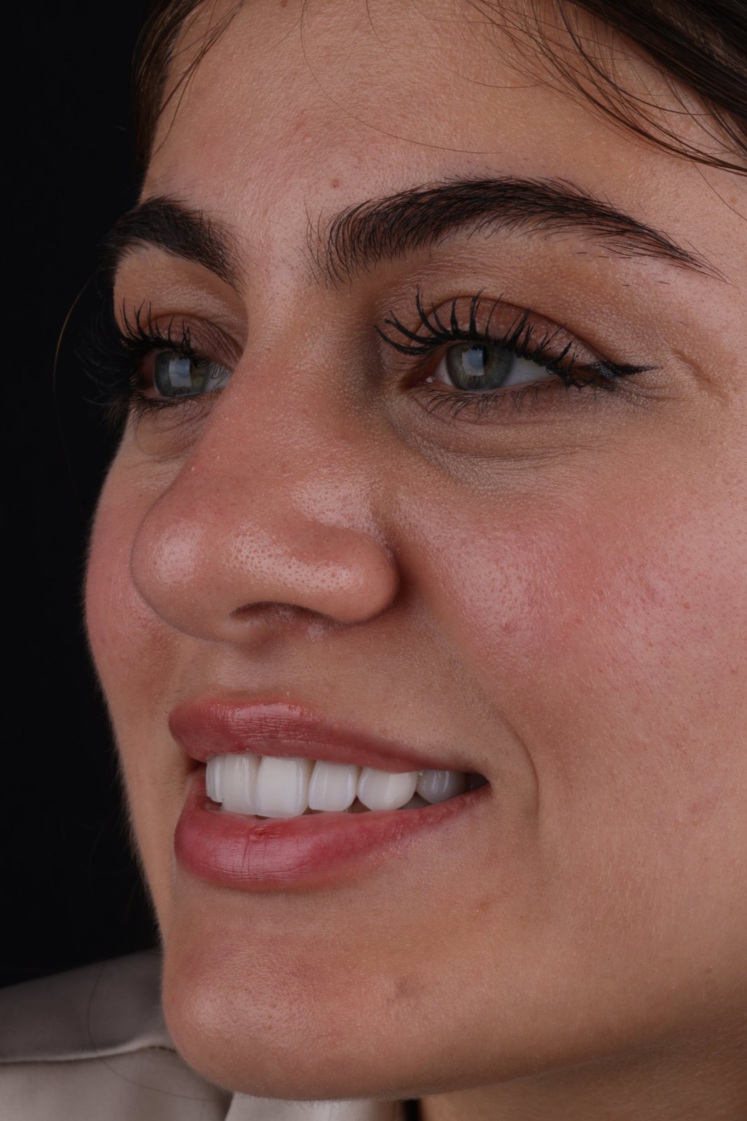 Smile with porcelain veneers — Creative Arts Dental & Aesthetics, Dubai