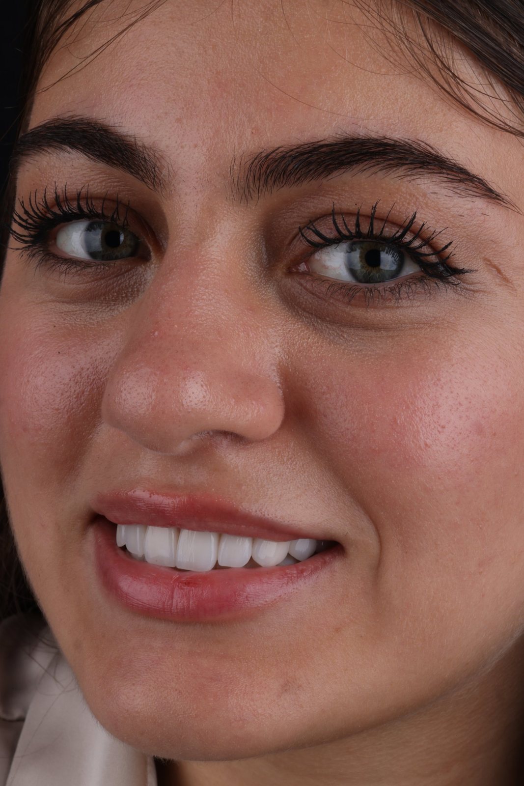 لبخند با لمینت — Creative Arts Dental & Aesthetics، دبی