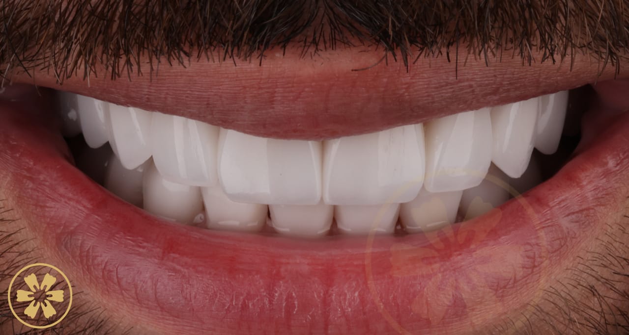 Before and after porcelain veneer result for Ahmad at Creative Arts Dubai