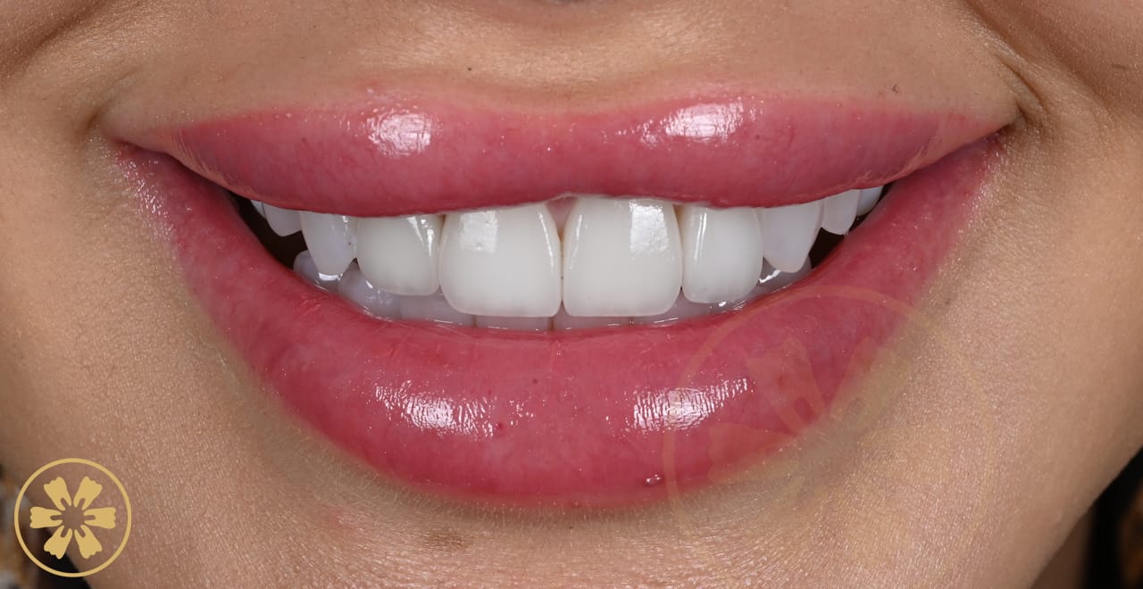 Before and after porcelain veneer result for Cynthia at Creative Arts Dubai