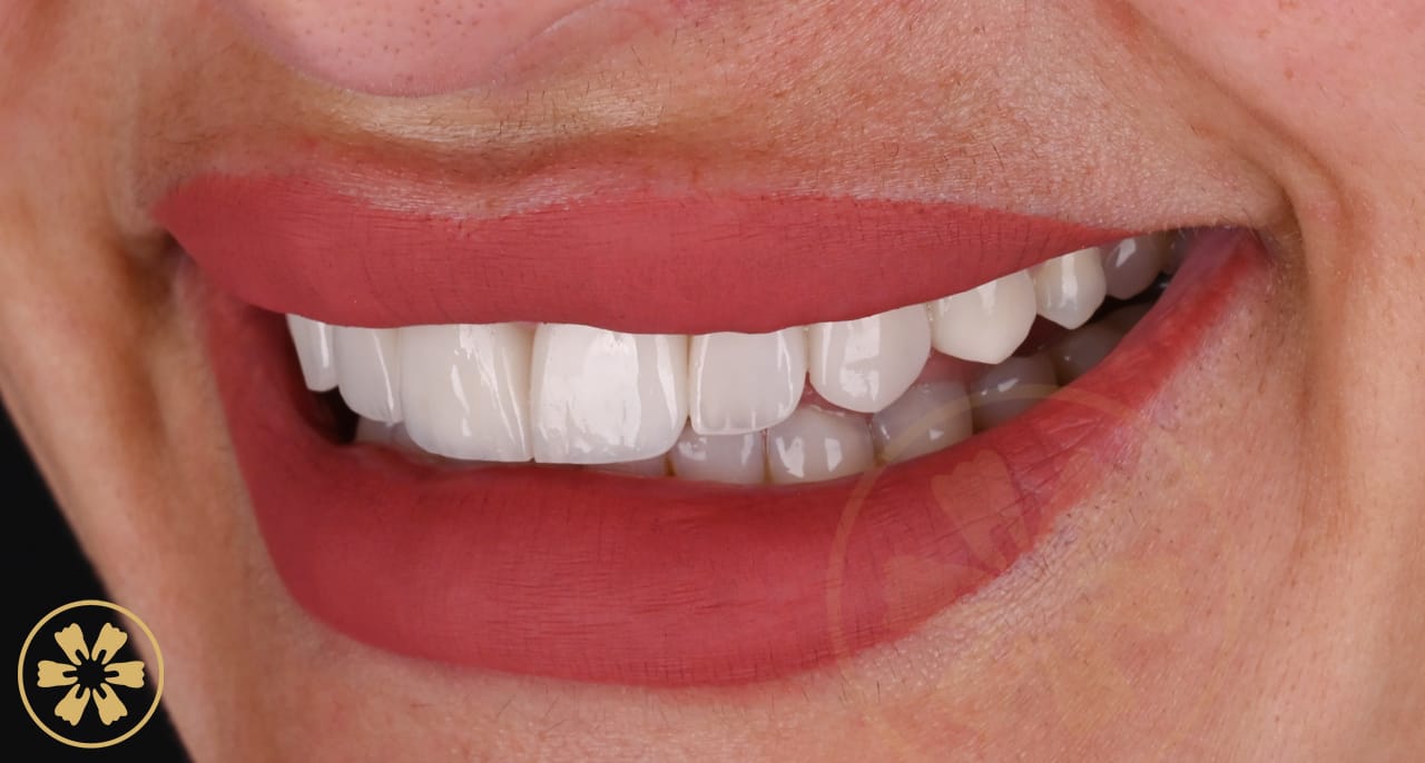 Before and after porcelain veneer result for Dana at Creative Arts Dubai