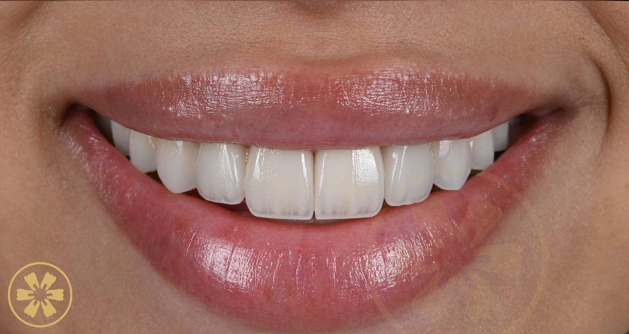 Before and after porcelain veneer result for Hadel at Creative Arts Dubai