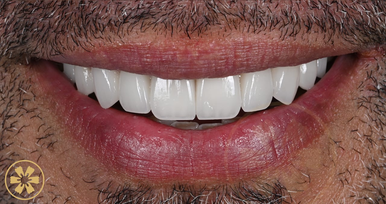 Before and after porcelain veneer result for Hesham at Creative Arts Dubai