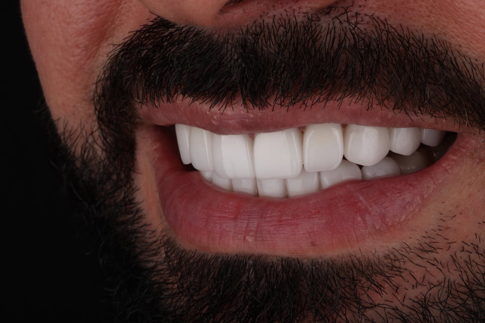 ابتسامة رجل ملتحٍ الجديدة بعد تجميل الابتسامة في دبي: لقطة أمامية لأسنان علوية وسفلية متناسقة ومشرقة (2)