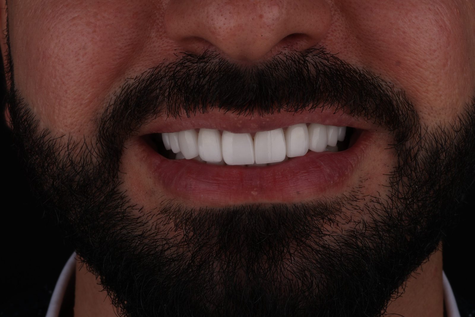 ابتسامة رجل ملتحٍ الجديدة بعد تجميل الابتسامة في دبي: لقطة أمامية لأسنان علوية وسفلية متناسقة ومشرقة (1)