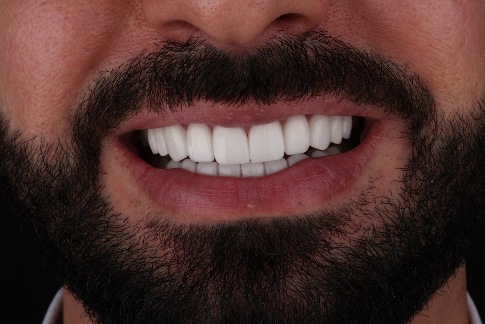 Bearded man's new smile after a smile makeover in Dubai: front close-up of even, bright upper and lower teeth