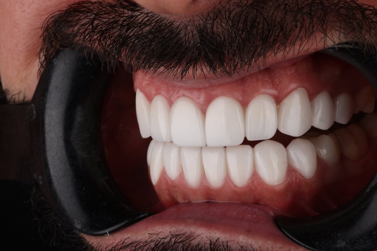 ابتسامة رجل ملتحٍ الجديدة بعد تجميل الابتسامة في دبي: لقطة أمامية لأسنان علوية وسفلية متناسقة ومشرقة (4)