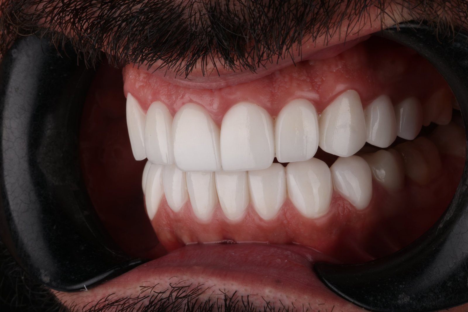 ابتسامة رجل ملتحٍ الجديدة بعد تجميل الابتسامة في دبي: لقطة أمامية لأسنان علوية وسفلية متناسقة ومشرقة (3)