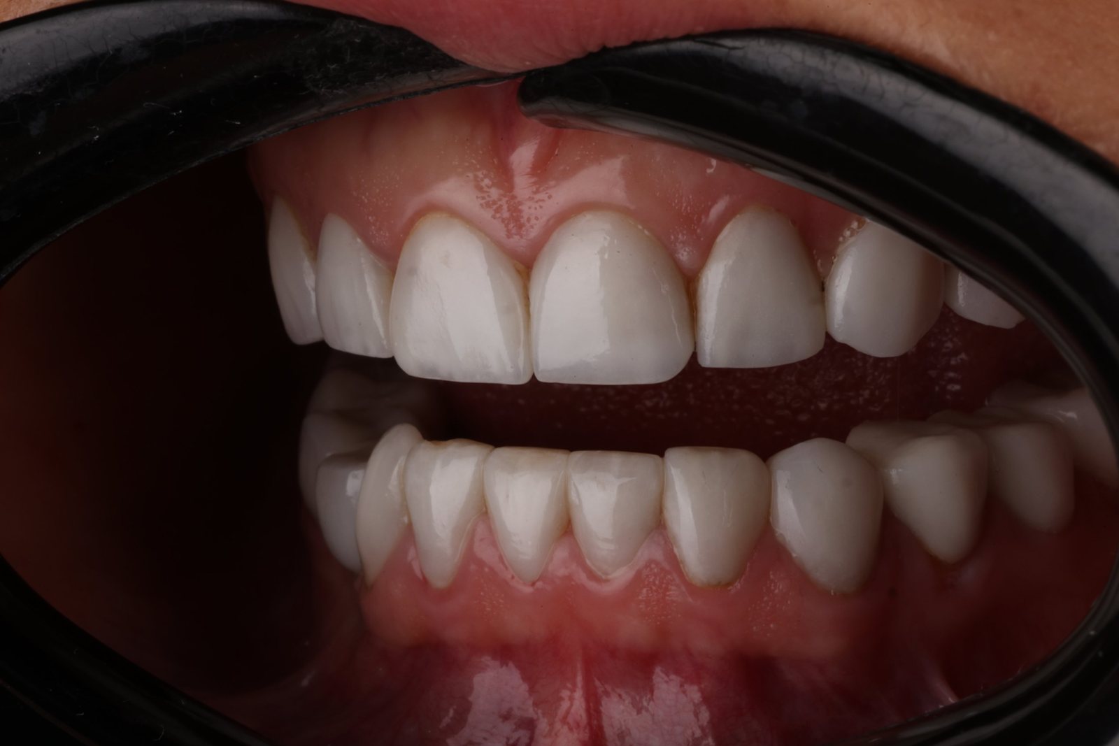 Woman's new smile after a smile makeover in Dubai: studio portrait and close-up of even, bright teeth (5)