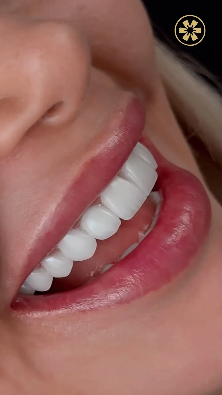 Un sorriso con faccette
